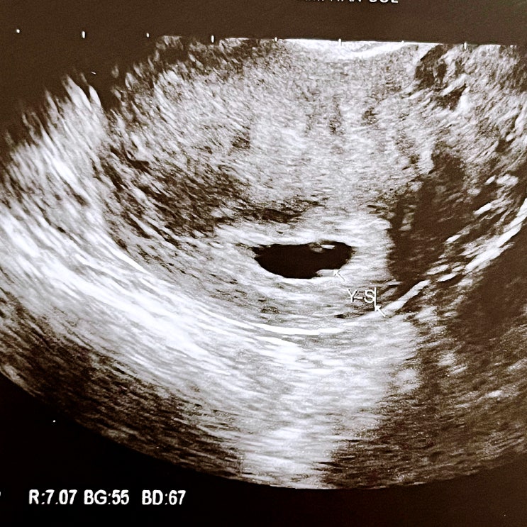  시험관 5일배양 2차 피검 수치는? 5주차 초음파 기록까지!