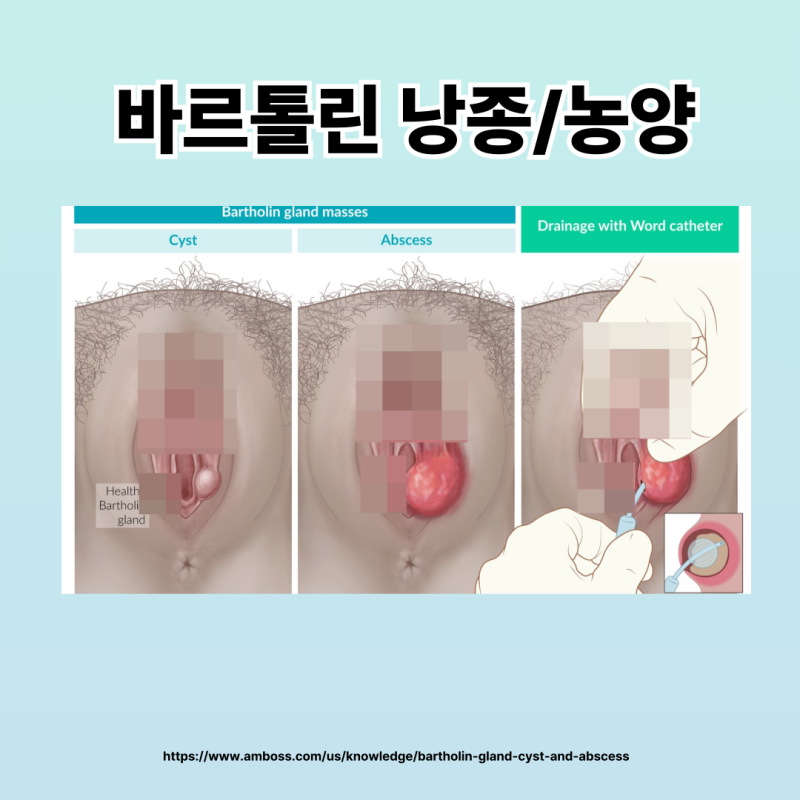 생식기 통증, 바르톨린 낭종 농양에 대하여 꼭 알아야 합니다