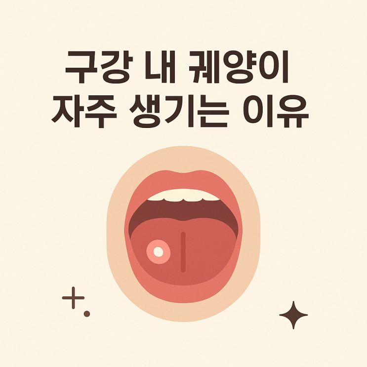   구강 내 궤양이 자주 생기는 이유