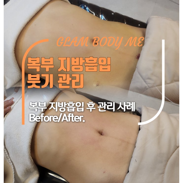  복부지방흡입붓기 오래가는 이유 (2주 차 - 5주 차) 비포 & 애프터