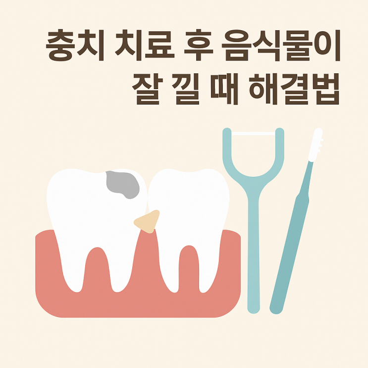   충치 치료 후 음식물이 잘 낄 때 해결법