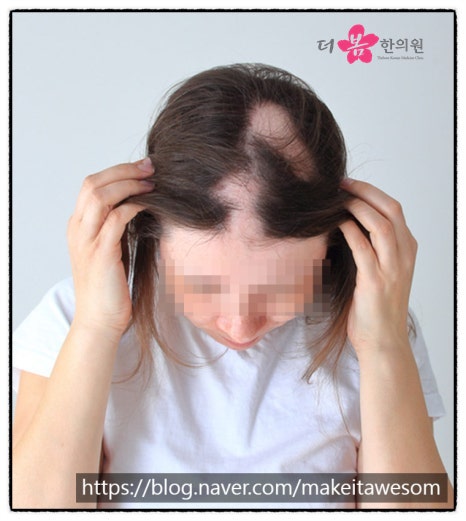 [인천원형탈모병원] 원형탈모 고민 빠른 치료가 중요