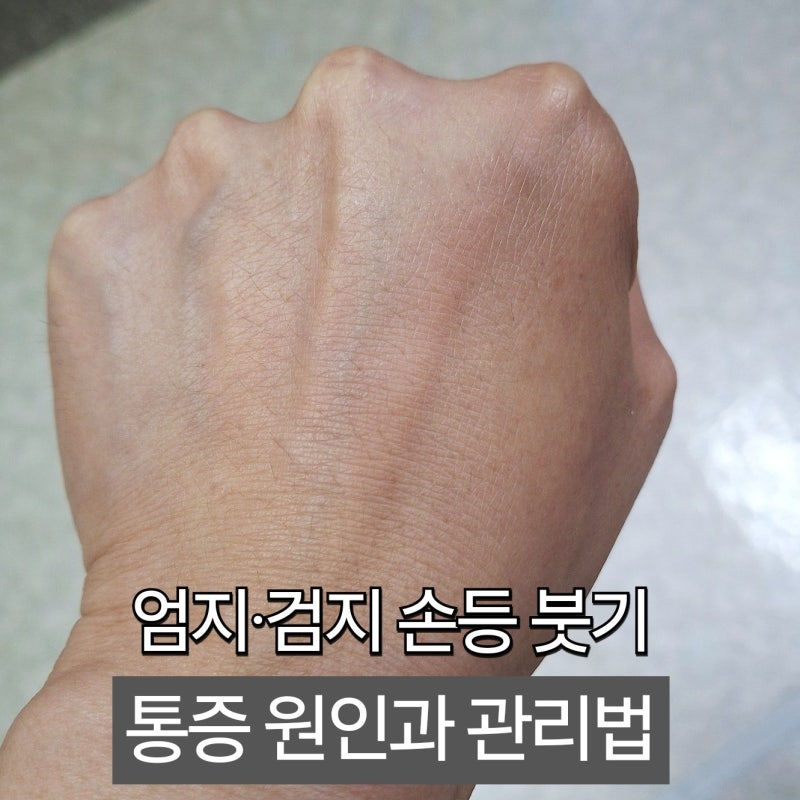 손등 붓기 원인과 관리법 | 엄지·검지 통증 완화 꿀팁