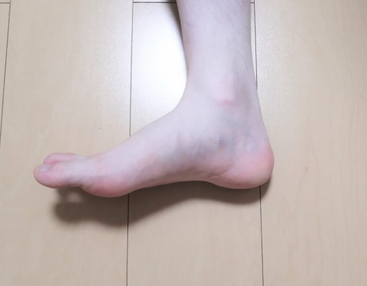  발목 안쪽 복숭아뼈 통증 운동 후 더 심해진 이유