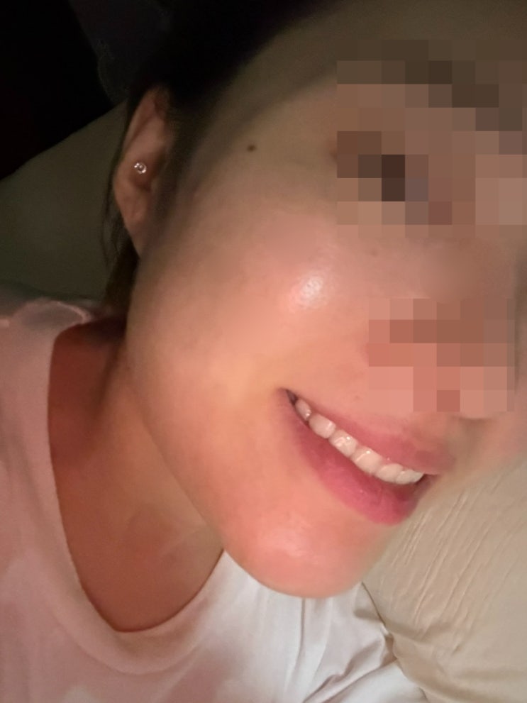 신사 온다리프팅 찐 후기! 6만 줄 받고 신사역 피부과에서 탄력 되찾은 썰 ^.^ (+전후비교)
