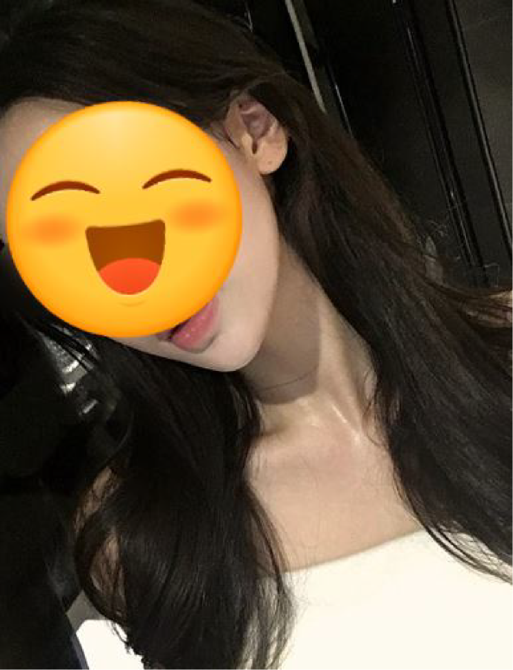 이마 지방이식 붓기 이것만 보세요