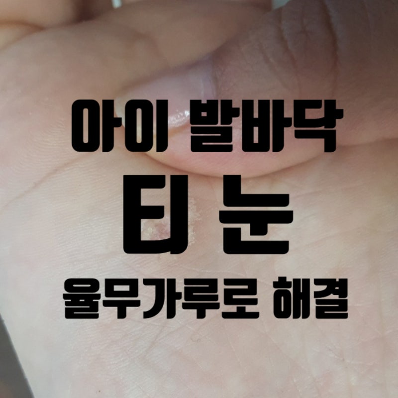 아이 발에 생긴 티눈, 율무가루로 해결한 경험담