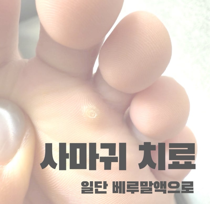 어린이 발바닥 사마귀 제거방법 냉동치료 전 베루말액으로