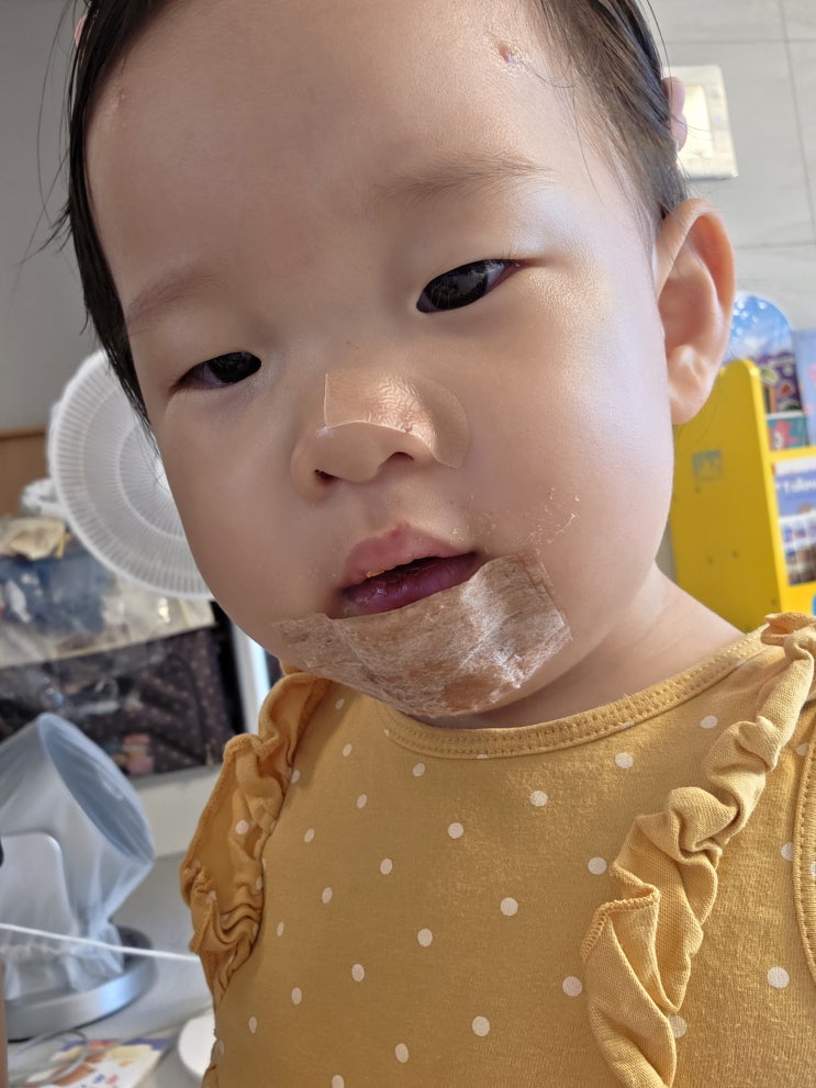  우리 아이 얼굴 찢어져서, 긴급 야간 봉합수술한 후기