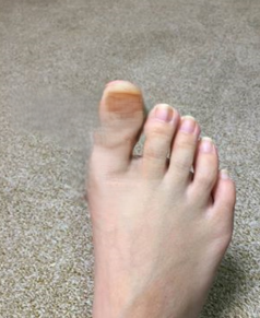 엄지발가락 통증 일상에 큰 불편 느끼고 극복한 사연