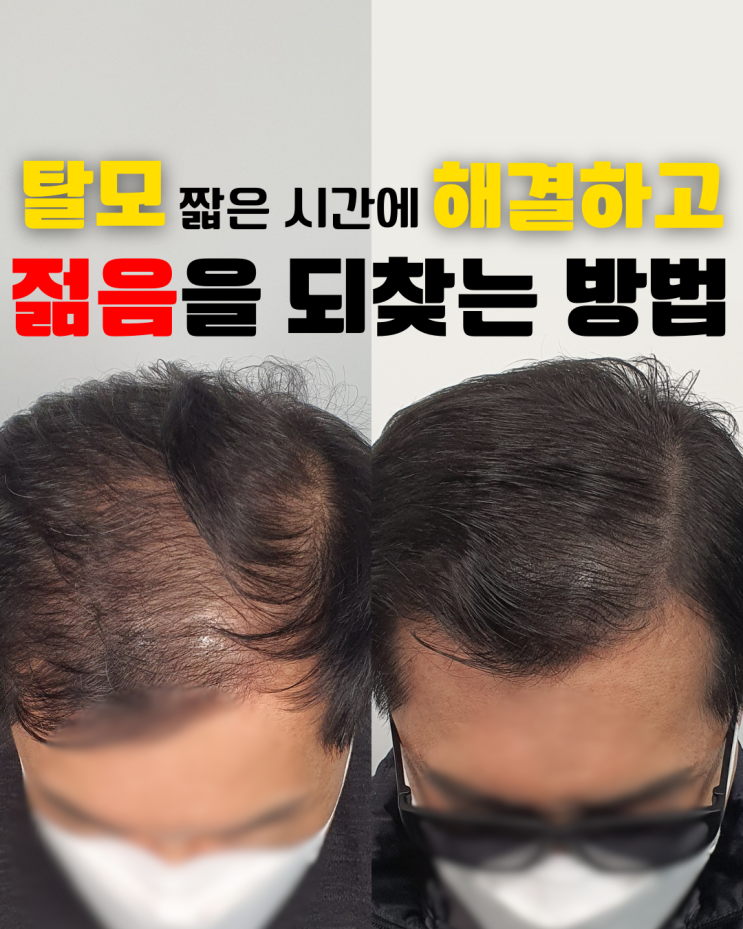  부산SMP 나이 들어 보이는 탈모, 짧은 시간에 해결하고 젊음을 되찾는 방법!