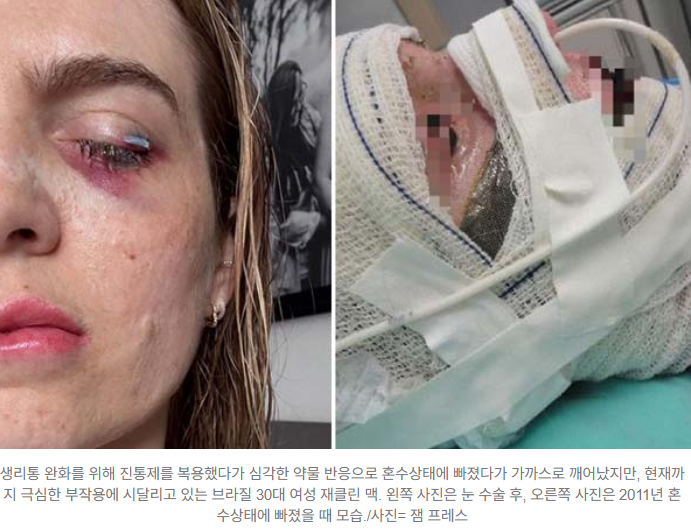   생리통 진통제 복용 후 혼수상태…시력 잃은 브라질 여성의 사연