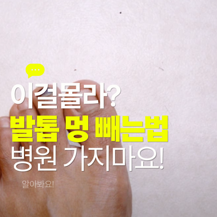  발톱 멍 병원 안가고 빼는법 통증 치료 연고 알아봐요!