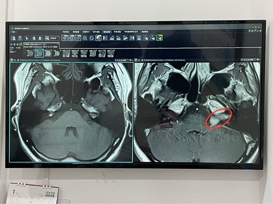 돌발성 난청, 뇌 MRI를 찍다, 나의 작고 안 귀여운 뇌종양, 청신경초종, MRI 비용, 청신경종양, ....