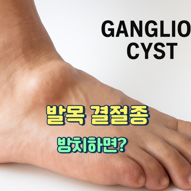  발목에 혹이 잡혀요 결절종일까? 증상과 한의원 치료법