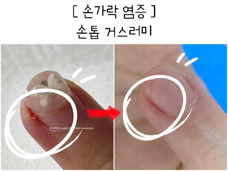 손가락 염증 손톱 거스러미 소염 진통제 항생제 상처 흉터 소독 연고