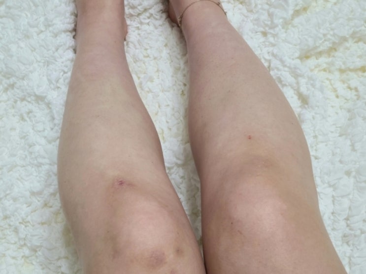  발란스핏 라인큐 부작용 없이 부종관리 중