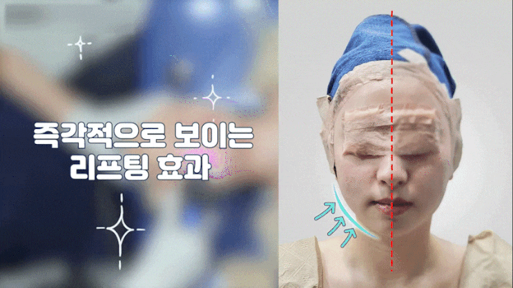  강남 티타늄 리프팅, 통증 없는 리프팅? 의사가 말하는 딱 맞는 환자 3타입!