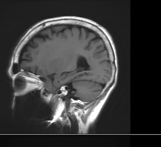  뇌 MRI 검사 비용 실비 머리 MRI 금식 입원 왜 할까?