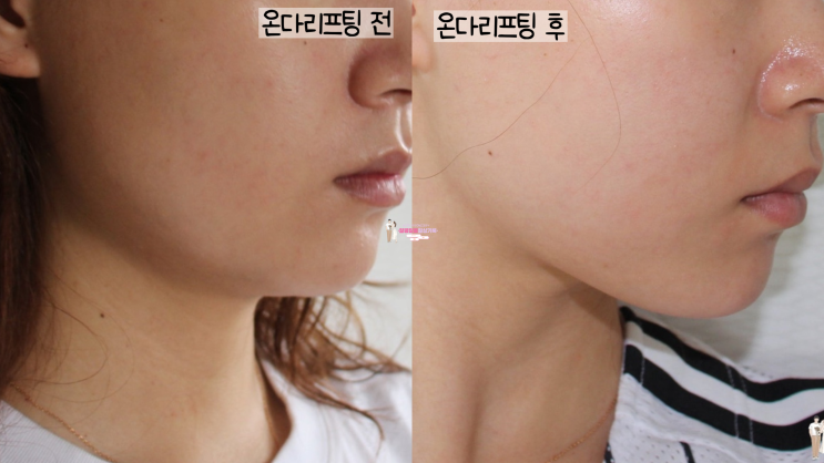  역삼동 피부과 온다리프팅 일주일 전후비교(사진有, 비용)