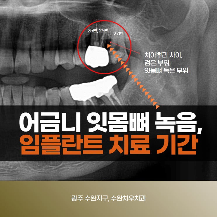  어금니 잇몸뼈 녹음, 필요한 치료와 임플란트 치료 기간