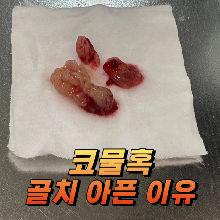  한국인들에게 잘 생기는 코물혹 유형과 치료법은