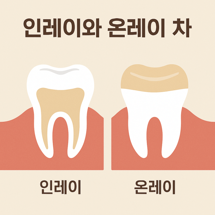   인레이와 온레이 차이