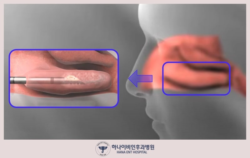 코막힘 심한 만성 비염 치료엔 고주파 비염수술