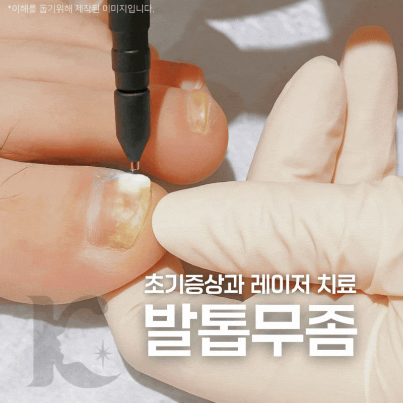 광주무좀병원 발톱 변형 및 색변화 부스러짐에 레이저 치료는