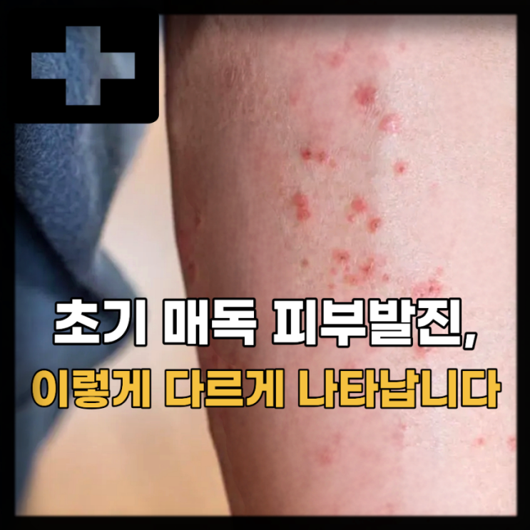  매독 초기 증상 검사, 여자 남자 매독 증상은?