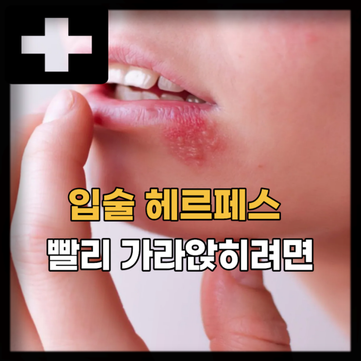  입술 헤르페스 원인 증상 연고, 구순포진 총정리