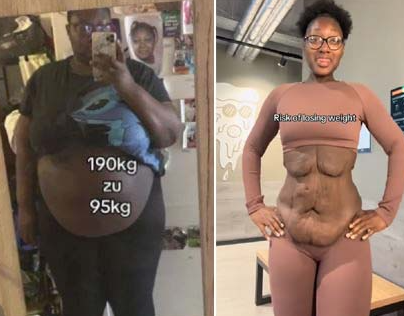  105kg 감량 후 “살보다 무서운 건 피부” 현실 고백 