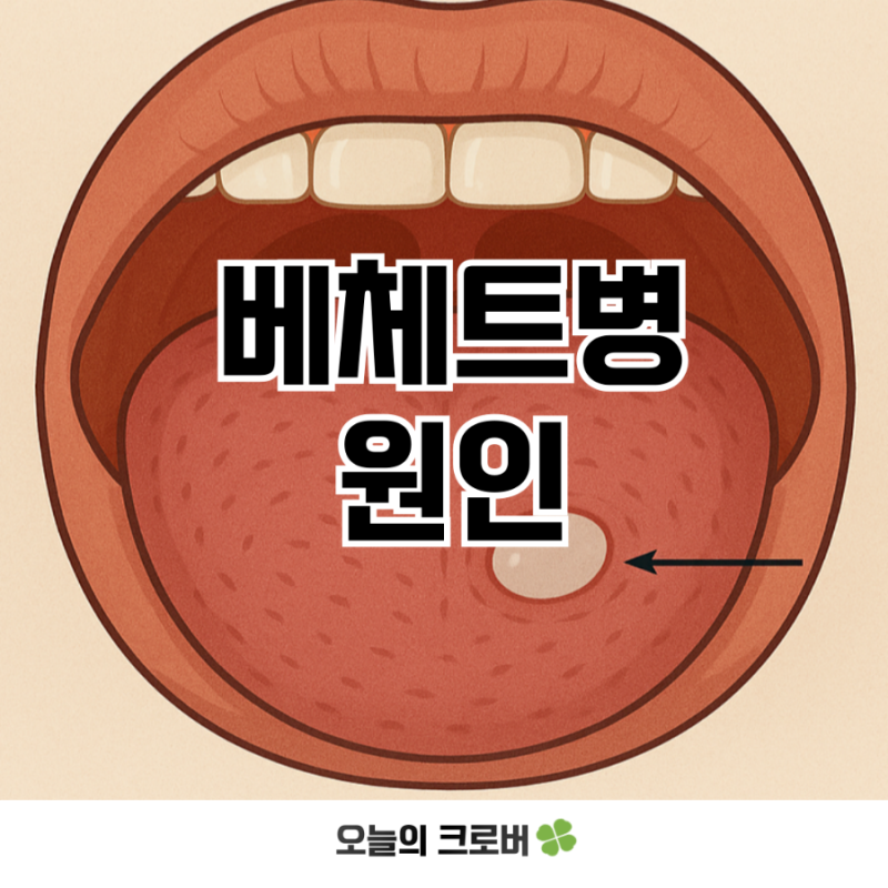 베체트병 원인과 치료, 유전과의 관계