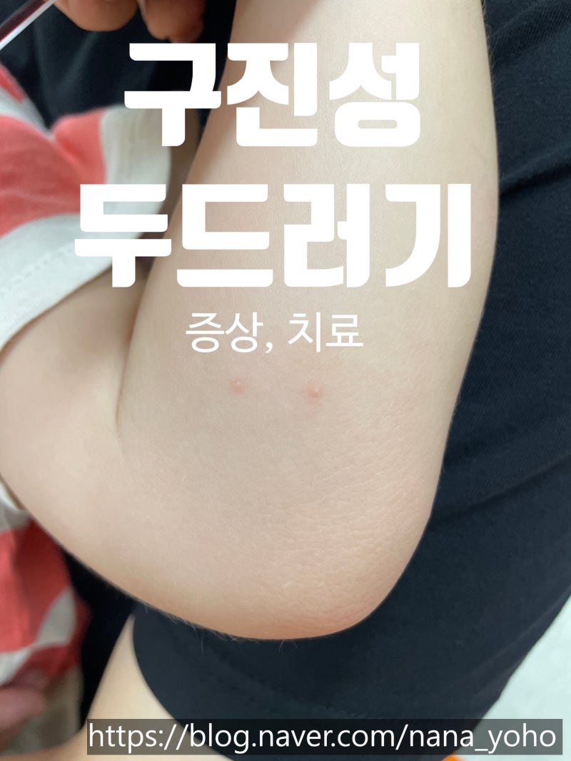 구진성두드러기. 증상과 치료방법. 피부과 다녀온썰.