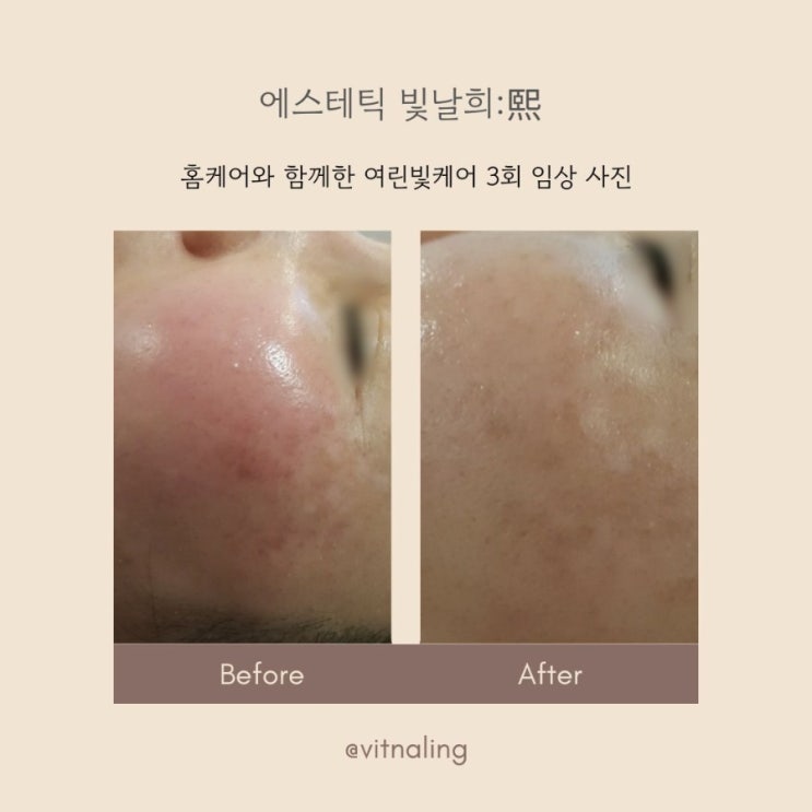  [에스테틱 빛날희 :熙] 광진구 군자역 7분, 여드름·홍조 피부 고민을 위한 프라이빗 관리