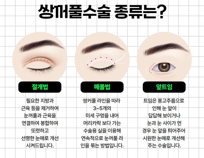 쌍꺼풀 수술 종류와 비용, 부작용까지 한눈에 정리