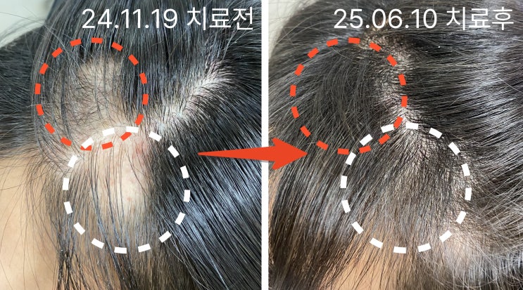  반복 발생하는 원형탈모, 재발걱정 덜어주는 치료방법은? (By 홍대 탈모치료)