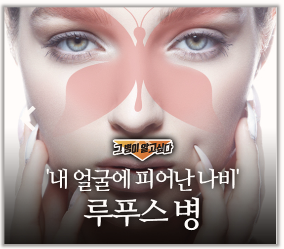 직접 겪어본 루푸스 관리 경험 원인부터 증상까지 쉽게 풀어본 이야기