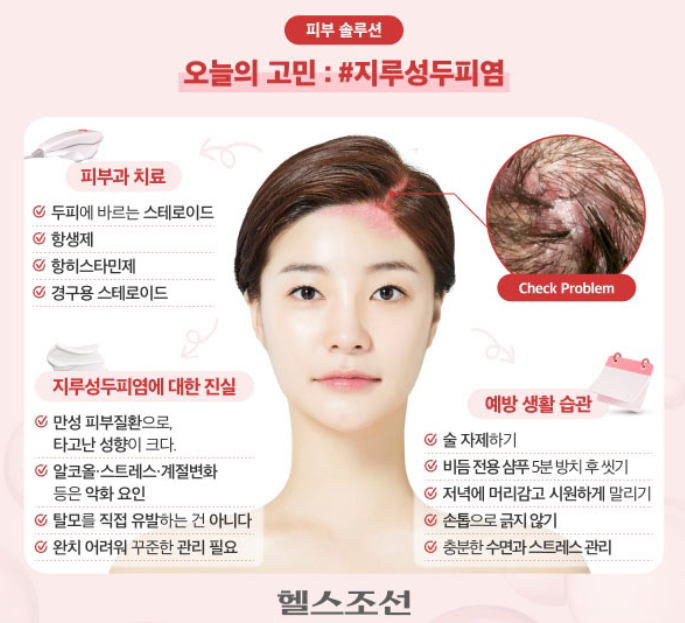  두피 가려움·비듬, 혹시 지루성두피염? 