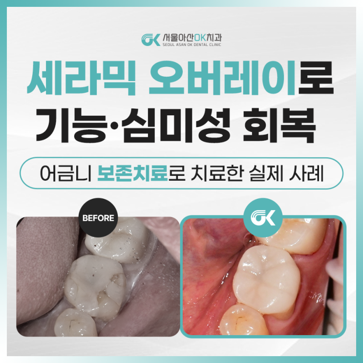  [임상사례] 양평읍치과 – 신경치료 없이 살린 어금니, 세라믹 오버레이 수복 사례