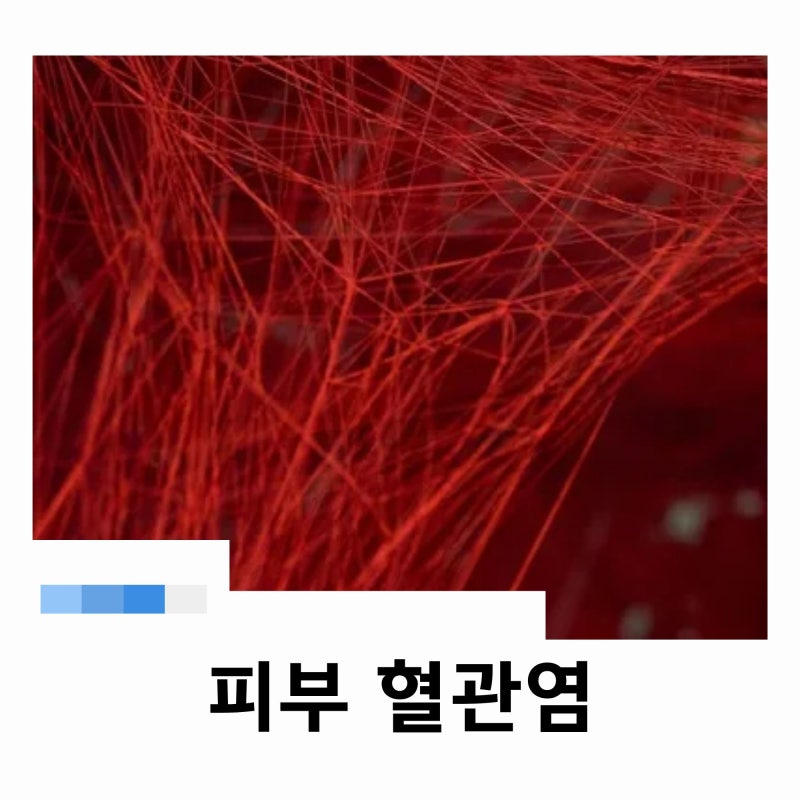 피부 혈관염 증상 왜 나타날까 치료