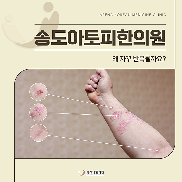 송도아토피한의원, 왜 자꾸 반복될까요?