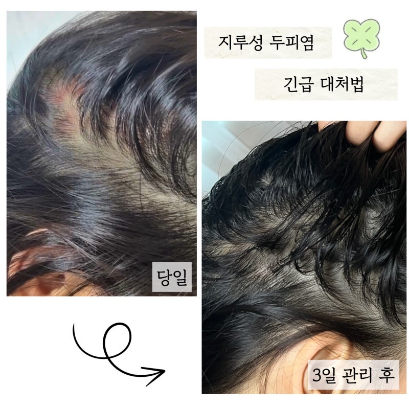지루성 두피염 긴급대처, 3일만에 가라앉힌 찐후기 및 관리법