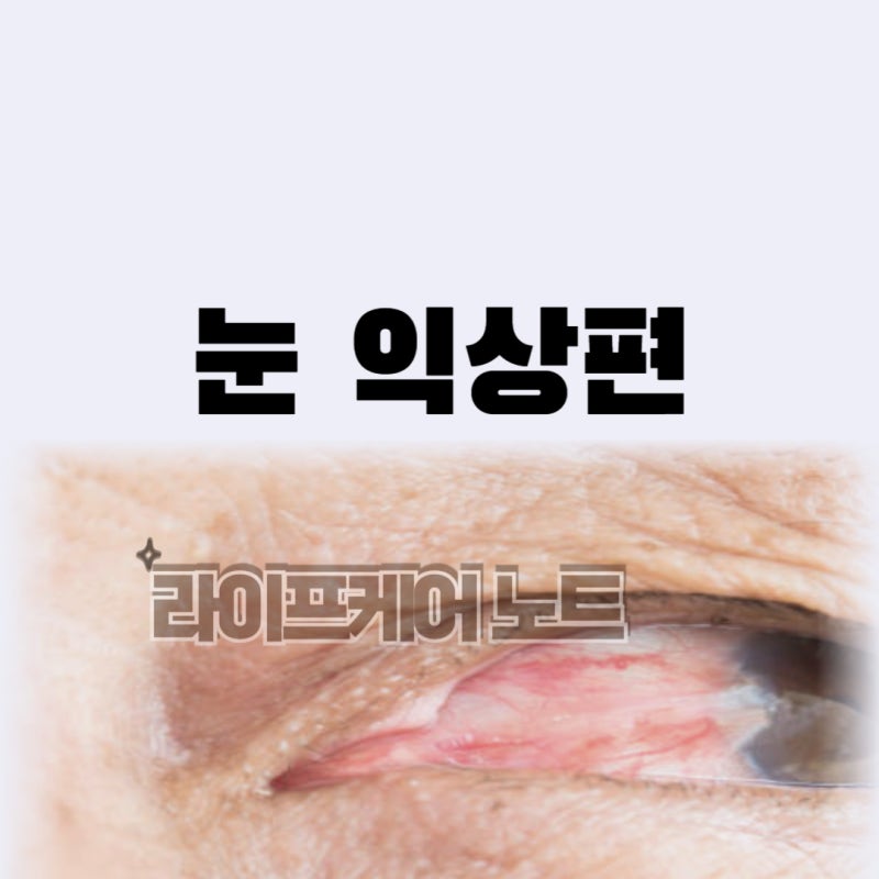 눈익상편수술 꼭 받아야 할까? 수술 방법 회복 재발 비용까지