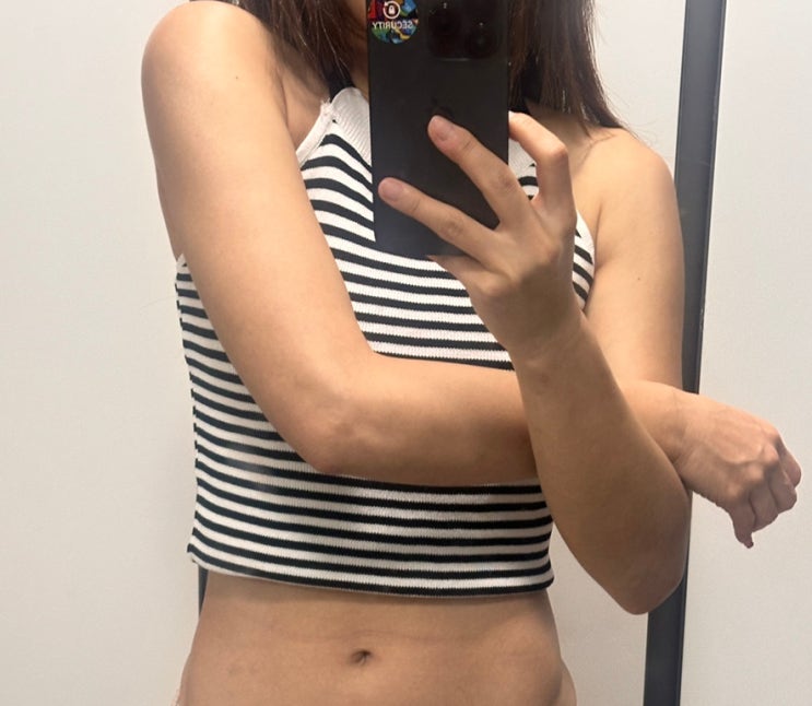  팔지흡 인천지방흡입후기, 가격, 붓기 관리 팁!