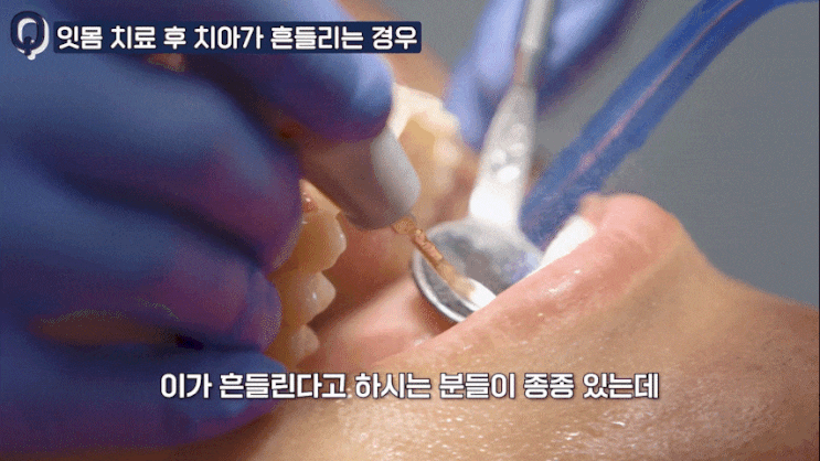  하남 미사 치과, 치아 흔들림 방치하면 위험한 이유? 자가 진단법 5가지