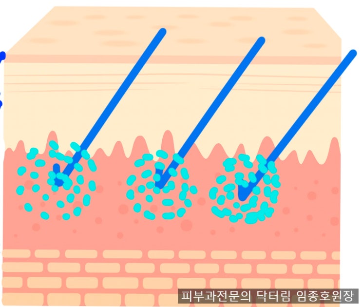  리투오 스킨부스터 - 주사, 캐뉼라 방식 2가지