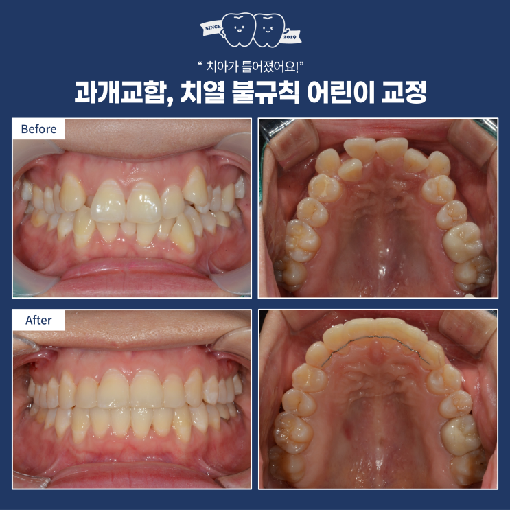  덧니와 불규칙한 치열, 발치 없이 교정 가능할까요? 하남 비발치 교정