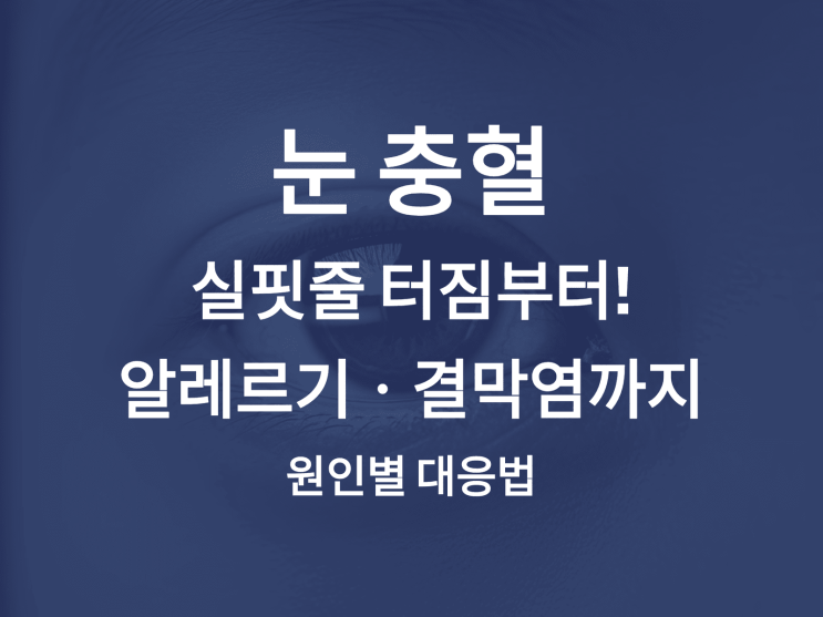  눈 충혈 실핏줄 터짐부터! 알레르기·결막염까지 원인별 대응법