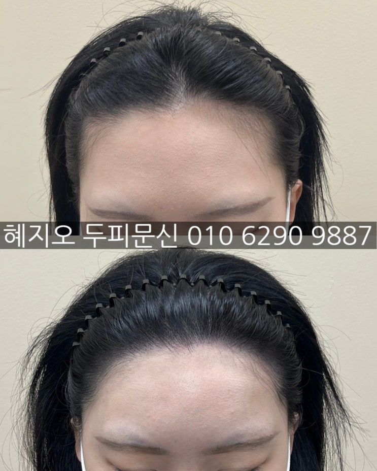  여자앞머리탈모 효과좋은 인천 헤어라인 두페페인팅 솔직후기